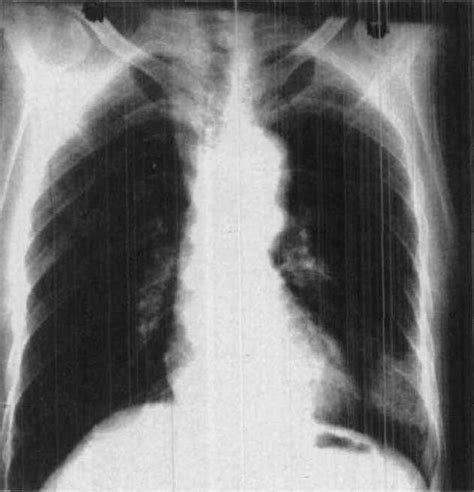 肺癌的四个肿瘤标志物 肺癌确诊的检查指标是什么意思？-觅健