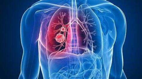 小细胞肺癌死前的15个征兆-有来医生