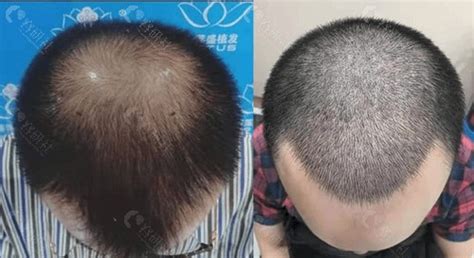 FUE和植发剃发/不剃发的区别是啥?不剃发植发的成活率更高吗,毛发整形对比照-8682赴韩整形网