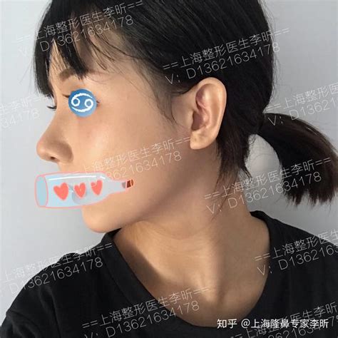 耳朵软骨突出图片