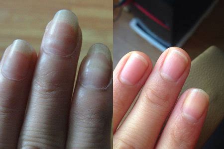 指甲的形状带来的暗示是什么-手指甲的表象都暗示身体出了什么问题？