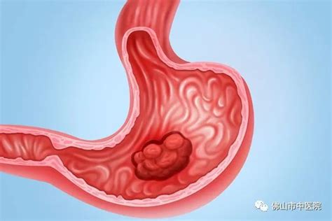 胃溃疡、胃癌的影像学表现 | 影像天地_互动