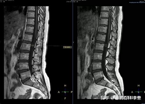 磁共振脊柱规范扫描及技术应用（腰椎部分） - 知乎