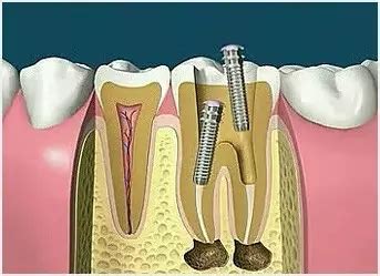 牙齿根管治疗费用一般多少钱?影响牙根管治疗收费标准有哪些?-欣美整形网