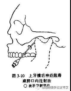 常用口腔阻滞麻醉的方法大全（转）-爱齿尔徐廷国的博客-KQ88口腔博客