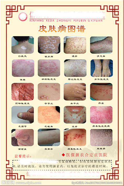 皮肤病的种类图片对照-中华银屑病网
