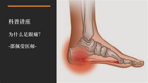 足底筋膜炎：脚后跟疼，简单3步，和疼痛说再见