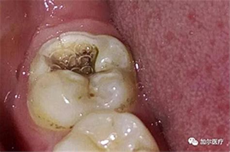 4颗大牙都长有黑线,为什么医生不让补牙？