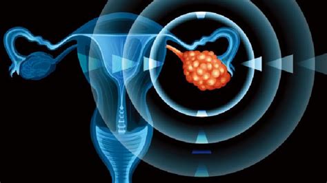 子宫内膜息肉需要怎么治疗才有效-子宫内膜息肉治疗-复禾健康