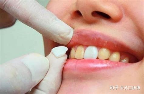 浅析洗牙、美白牙贴、冷光美白、牙齿贴面四种牙齿美白方式的区别！ - 知乎
