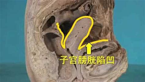 膀胱在哪个位置图图片 膀胱在哪个位置图图片