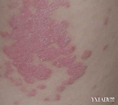 【图】红斑丘疹图片分析 教你识别红斑和丘疹的各种症状_伊秀美容网|yxlady.com