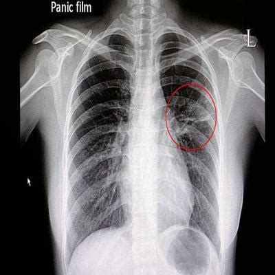 呼吸内科-间质性肺炎诊断-复禾健康