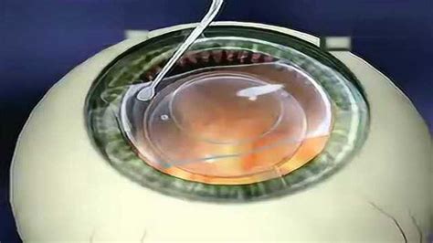 近视手术攻略-ICL晶体植入术篇 - 知乎