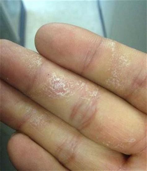手指水泡型湿疹图片 (3)_有来医生