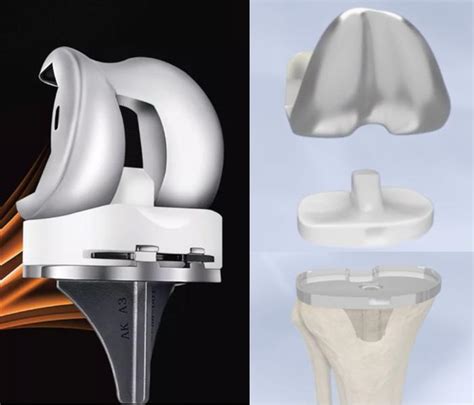 专为中国人设计的仿生骨结构！台湾工研院将于2018年推出3D打印仿生植入物-3D技术支持-上海数造