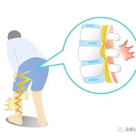 坐骨神经痛引起腿、脚麻是怎么了-有来医生