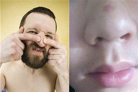 鼻子上长脓包型痘痘 顾名思义就是这种痘痘很容易流