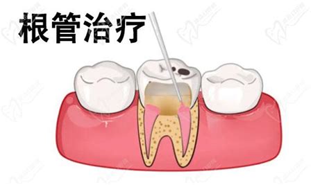 佛山口腔医院根管治疗费用:含前牙/后牙/二次根管收费标准,牙齿修复-8682赴韩整形网