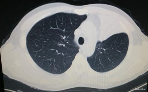 肺癌早期一定要做手术治疗吗？哪种方式治疗肺癌比较好？_肿瘤_医生在线
