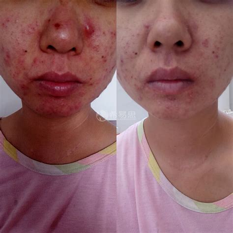 我脸上的红色痘印七八个月了，一直不下去，我该怎么办。？ - 知乎