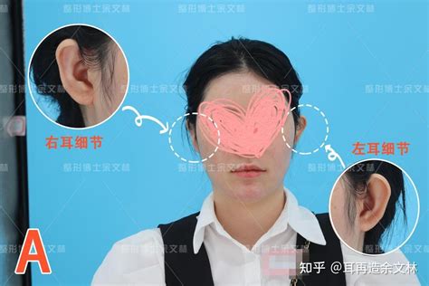 耳朵软骨突出图片