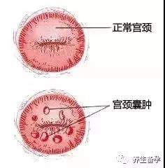 纳氏囊肿图片