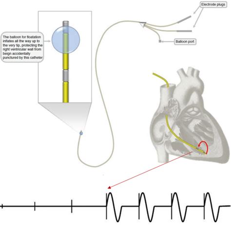 心脏起搏器的发展与变迁_应用_导线_患者