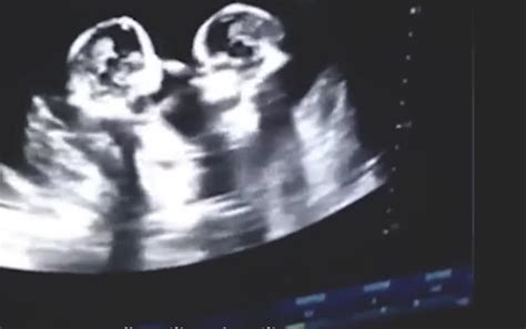 双胞胎在宝妈肚子里打架,镜头拍下全过程,看完不许笑|宝妈|双胞胎|肚子_新浪新闻