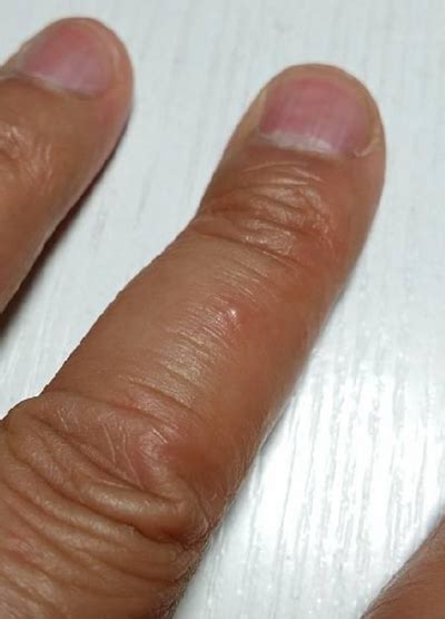 手指水泡型湿疹图片 (26)_有来医生