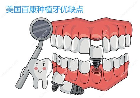 镶牙多少钱一颗2023,烤瓷牙500元/全瓷牙1200元/种牙4500元 - 口腔资讯 - 牙齿矫正网