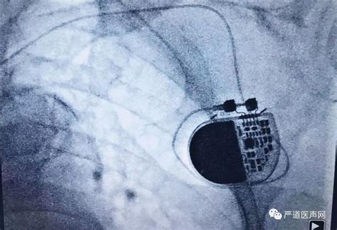 无线充电技术在医学上的应用给医用植入设备（心脏起搏器）进行充电 - 行业新闻
