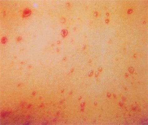 艾滋病斑丘疹症状-艾测网