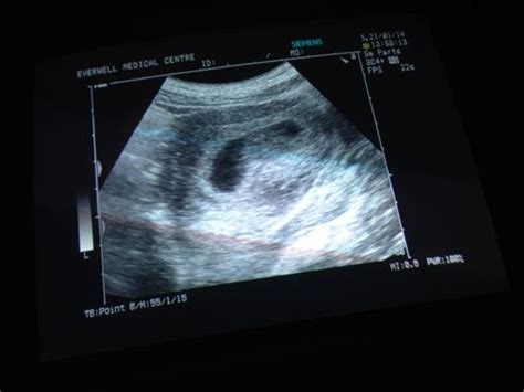 为什么要在来月经的第二第三天来做阴道B超 为了定制试管婴儿促排卵方案-深圳中山妇产医院