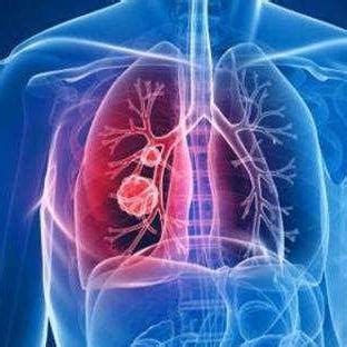 非典型肺炎病原体概述-肺炎概况-复禾健康