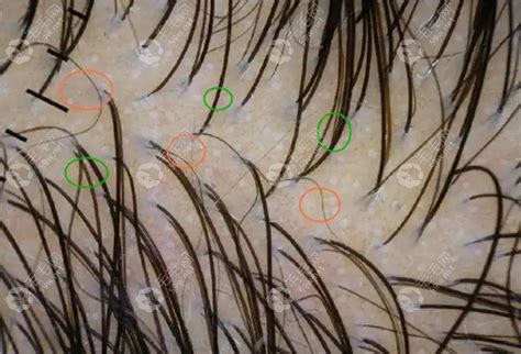 脱发后当我们谈毛囊检测时，我们在检测什么？