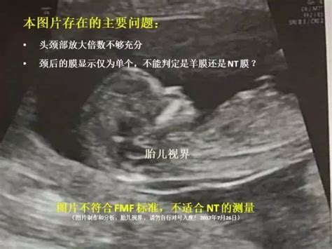 孕妈们，你的胎儿的 NT 检查结果可靠吗？ - 知乎