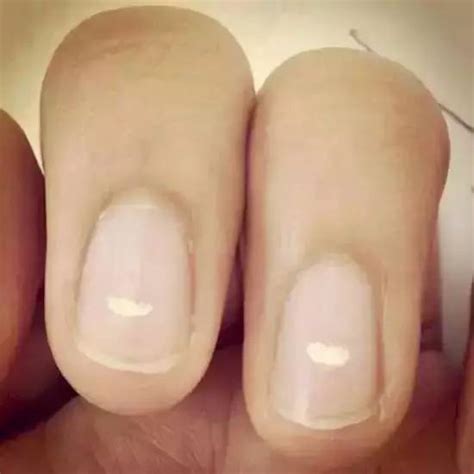 指甲竖纹多是癌症 一是指甲甲母部位出现了一种色