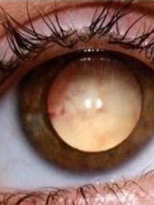 重瞳的症状图片-重瞳图片大全-重瞳-39疾病百科