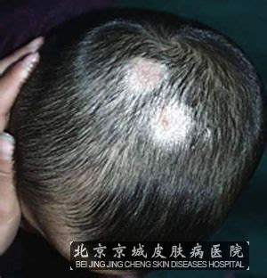白癣图片