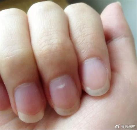 【图】带你了解手指甲分层图片 为你分析指甲分层的原因_手指甲分层图片_女物美容网|nvwu.com
