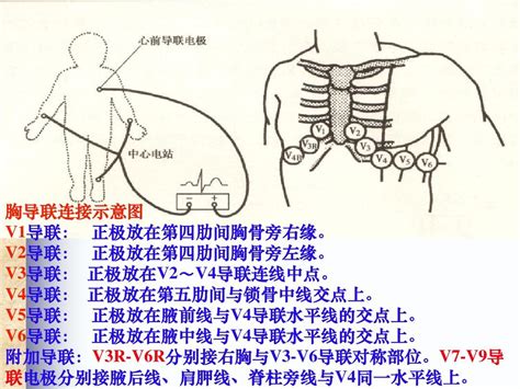 心电图连接示意图图片