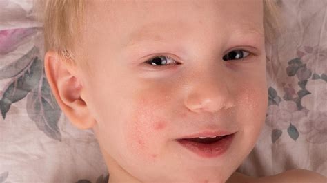 荨麻疹治愈率-荨麻疹怎么治愈-荨麻疹治愈方法-复禾疾病