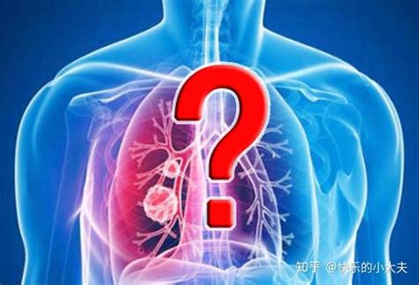 什么样的肺结节是肺癌？6类人要小心，发现结节这样做才安心 - 知乎