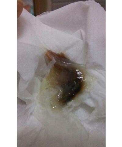 血性分泌物图片