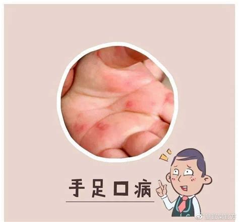 轻微手足口病图片