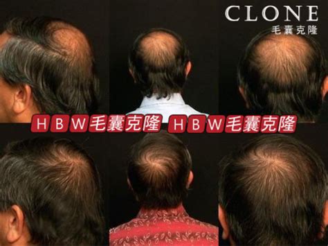 hbw毛囊克隆植发是骗局?做一次hbw毛囊克隆只能维持两年是吗?,毛发整形对比照-8682赴韩整形网