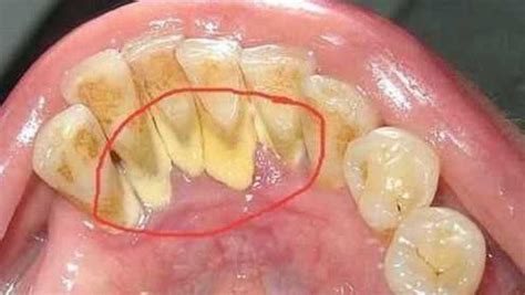 你的牙齿内侧有没有又黑又臭的牙菌斑？教你不用洗牙自己去除它