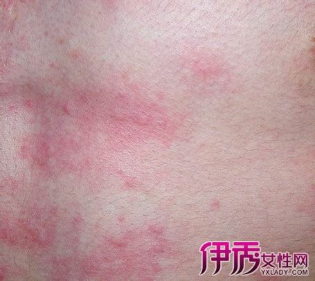 人工荨麻疹的注意事项是怎样的呢_荨麻疹_北京京城皮肤医院(北京医保定点机构)