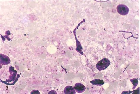 耶氏肺孢子虫(卡氏肺孢子虫)-综合性临床细胞学图-医学